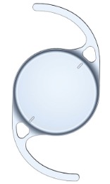 Chirurgie de la cataracte : Implant torique